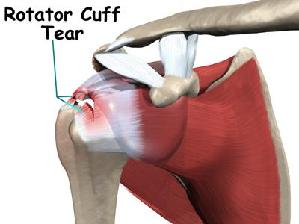 Neck Pain  Cedars-Sinai